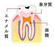 軽度のむし歯