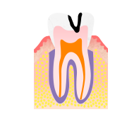 中度のむし歯