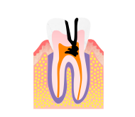 重度のむし歯